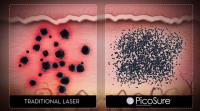 Laser Treatment Tattoo – Atherton Clinic image 1